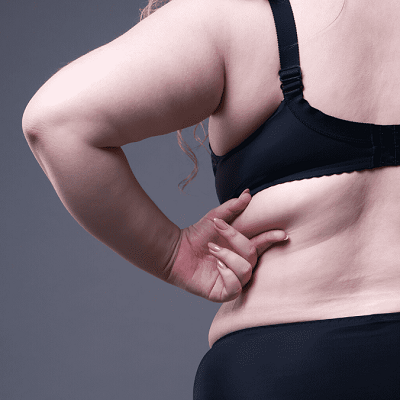 Bra Line Lift Surgery Cost in Abu Dhabi Al Ain Back Lift