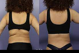 Bra Line lift surgery Clinic in Abu Dhabi