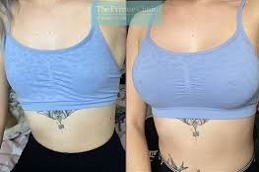 Breast Enlargement Injections in Abu Dhabi