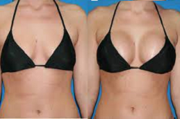 Breast Implants Clinic in Abu Dhabi UAE