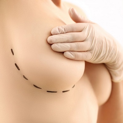 Breast Lift Surgery in Abu Dhabi & Al Ain Mastopexy Surgery UAE