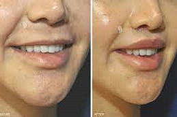 Bullhorn lip Lift in Abu Dhabi