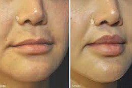 Bullhorn Lip Lift 8 Bullhorn lip Lift