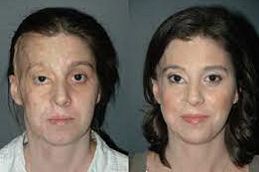 Burn Reconstructive Surgery Clinic in Abu Dhabi &Al Ain