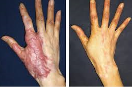 Burn Reconstructive Surgery Clinic