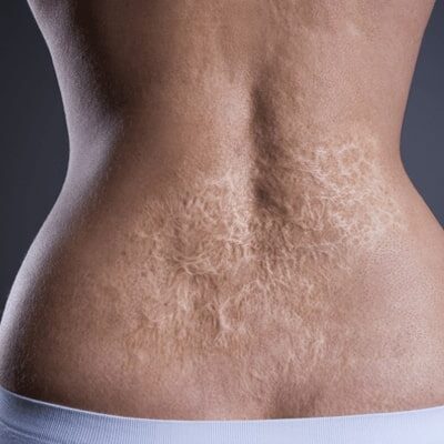 Burn Reconstructive Surgery in Abu Dhabi