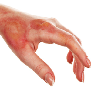 Blog 17 Burn RecostructionSurgery Clinic