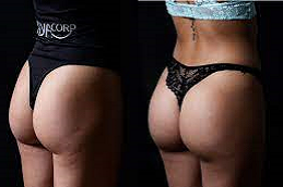 Butt Fillers Clinic in Abu dhabi