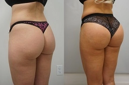 Buttock-Lift-in-Abu-Dhabi-Al-Ain-Before-After