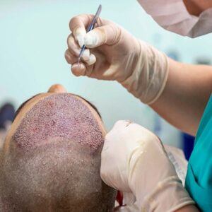 Blog 8 Cheap-Hair-Transplantin Abu Dhabi Al Ain Cost Benefits