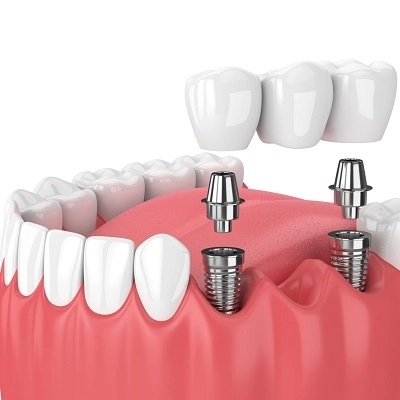 Dental Implants 2 Cheapest Dental Implants in Abu Dhabi & Al Ain Implants Cost