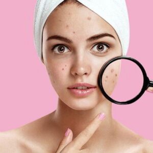 Blog 1 Chemical Peels for Acne Scars IN Abu Dhabi Al AiNPeels for Acne