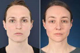Chin Reduction Clinic in Abu Dhabi & Al Ain