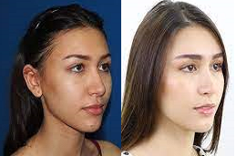 Chin Reduction Clinic in Abu Dhabi
