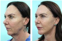 Chin Reduction 5 Chin Reduction Clinic