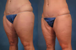 Circumfrential Abdominoplasty