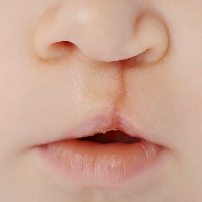 Cleft Lip Surgery (Craniofacial) 2 Cleft Lip and Palate Surgery in Abu Dhabi