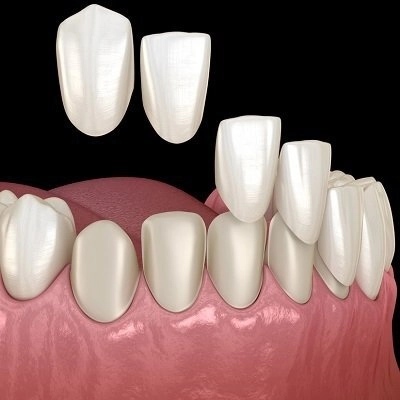 Composite Veneers in Abu Dhabi & Al Ain | Composite Veneers Cost