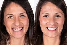 Composite-Veneers-in-Abu-Dhabi
