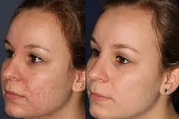 Deep-Cleansing-Facial-Clinic-in-Abu-Dhabi