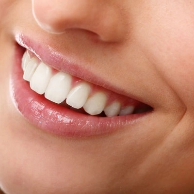 Dental Bonding Cementing 2 Dental Bonding Cementing in Abu Dhabi & Al Ain Dental Royal Clinic