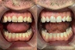 Dental-Stains-Removal-in-Abu-Dhabi-Al-Ain