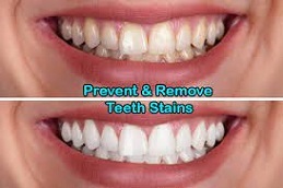 Dental-Stains-Removal-in-Abu-Dhabi