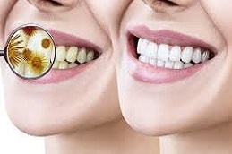 Dental-Stains-Removal