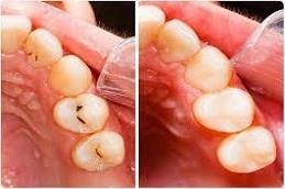 Dental Tooth Filling Treatment 5 Dental-Tooth-Filling