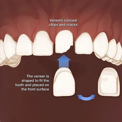 Gum Bleeding Treatment 2 Dental Veneers In Abu Dhabi & Al Ain Dental Veneers Charges