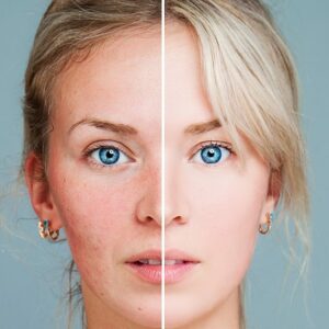 Blog 15 Dermal Fillers for Effective Acne Scar Treatment in Abu Dhabi