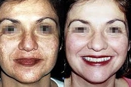 Dermamelan-Peel-in-Abu-Dhabi-Al-Ain