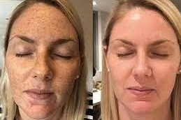 Dermamelan-Peel-in-Abu-Dhabi