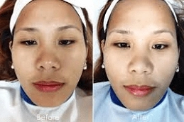 Diamond-Peels-Clinic-in-Abu-Dhabi-Al-Ain