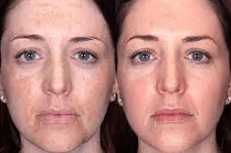 Diamond-Peels-in-Abu-Dhabi-Al-Ain