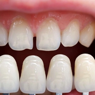 E-Max Veneers 2 E-Max Veneers in Abu Dhabi & Al Ain Veneers Cost & Price