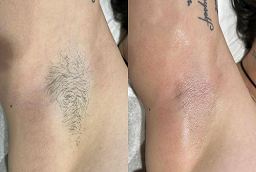 Electrolysis Laser Hair Removal After and Before