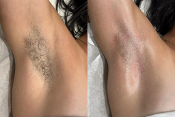 Electrolysis Laser Hair Removal Before and After