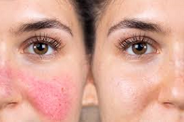 Facial-Capillaries-Treatment-Clinic-in-Abu-Dhabi