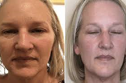 Facial Capillaries Treatment 5 Facial-Capillaries-Treatment-in-Abu-Dhabi