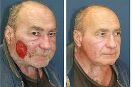 Facial Scar Revesion Clinic in UAE