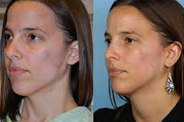 Facial Scar Revesion in Abu Dhabi & Al Ain