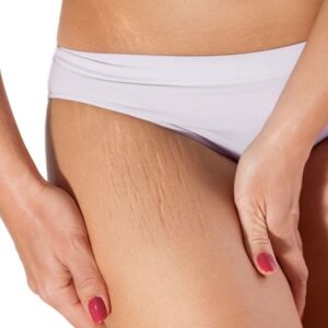 Blog 15 Flawless Stretch Marks Removal Cost in Abu Dhabi Al Ain
