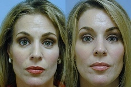 Forehead-Lift-Surgery-in-Abu-Dhabi-Before-After