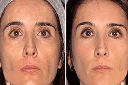 Fotona 4D for face in Abu Dhabi UAE