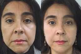 Fotona 4D for face in Abu Dhabi