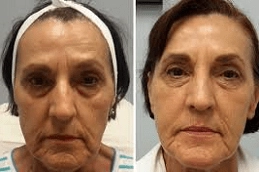 Fractional Crabon Laser Clinic