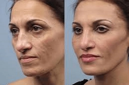 Fractional Laser Carbon Peel in Abu Dhabi
