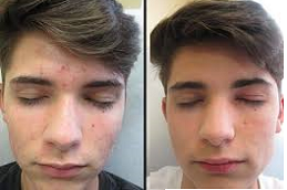 Freckless and Belmishes Clinic in UAE