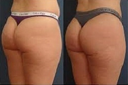 French-butt-reshaping-in-Abu-Dhabi-Before-After